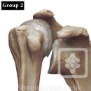 어깨 인공관절 수술 total shoulder arthroplasty, reverse shoulder arthroplasty 이미지