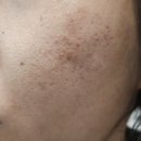 선명한의원 | 피부과 한의원 새살침 흉터 제거 솔직 후기