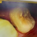 서울탑치과의원 | 은평구 불광역 365서울탑치과의원에서 신경치료 완료, 마취주사가 신세계