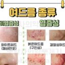 좁쌀 붉은 화농성 결절성 여드름 종류 &amp; 여드름 항생제, .압출 이미지