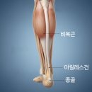 화정으뜸마취통증의학과의원 | 아침에 심해지는 뒷꿈치통증, 가벼운 피로누적이 원인일까요?