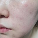 길안한의원 | [공지] 부산모공주사 :메디컬오셈텀점에서 특허받은 모공리액터로 모공고민 잡아요 : )