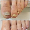 반디약국 | 천안두꺼운발톱 불당동에서 관리 받고 새 발톱 찾았어요