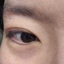 9 | [내돈내산] 대구 쌍수 후기 (9일차~3주차, ㅇㄷㄱㅇㅇ 완전절개+눈매교정)