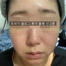 주사피부염 치료 연고 안 쓰고 한의원 다니며 해결한 후기