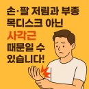 손·팔 저림과 부종, 목디스크인 줄 알았는데… 원인은 사각근? 이미지