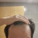 Kprean hair transplant during 4 days in turkey