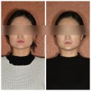 목포피부관리 &#34;스파뷰타임&#34; JH윤곽술 본식 전 관리후기