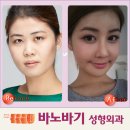 역삼바노바기성형외과 네이버블로그