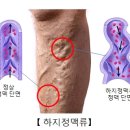 하지정맥류 증상과 원인 주의사항 이미지