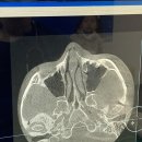 꽃보다이비인후과의원 | [인천 구월동] ‘꽃보다 이비인후과’ 🏥 인천 구월동 꽃보다 이비인후과 코 골절 수술 후기