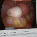 아림가스 | 20대 난소기형종 복강경수술 2박 3일 입원 후기