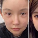 왕징-1 | [상하이여행] 중국 왕징성형 후기, 필러 부작용 직쏘얼굴 탈출_*긴 글 주의