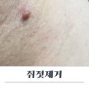 조은항외과의원 | 출산 후 겨드랑이 비립종 쥐젖 외과 제거 후기