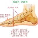 통풍성 관절염 기혈치료 (Gout Arthritis QiHyul Theraphy) 이미지