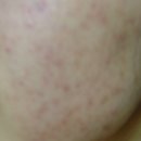 그린셀의원 | [수험생할인이벤트] 여드름치료후기와 여드름치료전후사진 사례