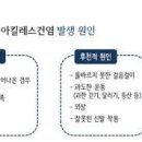 아킬레스건염 원인 및 증상 치료 이미지