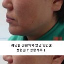 충주최남렬성형외과 얼굴당김술 성형전후 이미지