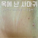 노들담한의원 | 목 편평사마귀 제거 후기가 궁금하다면?