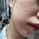 평촌자연과한의원 | 범계 한의원 가로세로한의원 안양평촌점 _ 물광필링 피부 관리 일주일 경과 솔직후기