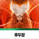 후두암 초기 증상 후두암 원인 치료 후두암 자가 진단 이미지