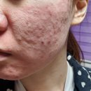 살롱드스킨(Salon de Skin) | 김포여드름압출 깐달걀 윤광피부 8년차 구래살롱드치유 필터샷