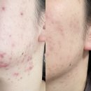 131 | 셀라딕스 131 앰플 후기, 반복되던 여드름 루틴 바꾼 방법