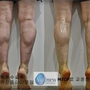 Re:종아리신경절제술 <<밸리뉴입니다.>> 이미지