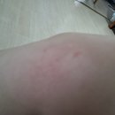 오늘아침네번째 벌침 이미지