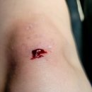 드림메디랩 | 찰과상 맛집 소독 연고 드레싱 순서 알려드림 혐오주의