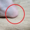 미르약국 | 발뒤꿈치각질제거 크림 써본 찐 후기!(+원인)