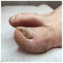 동성메디칼(주) | 광명발톱무좀 내성발톱까지 확실하게 해결 포쉬네일 동성제약 풀리메디 족보있는그녀들 금천점