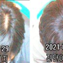 이안두피탈모 이미지