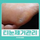 테크노메디컬타워 서편 | 달성군 티눈 제거해도 계속 아프신가요?