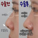 코원성형외과의원 | 짧은코교정, 코끝연장이 핵심입니다.