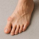 엄지 | 무지외반증 교정기 후기 엄지발가락휨 발바닥통증 관리