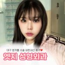 대구 쌍꺼풀 수술 내돈내산 후기, 엣지 성형외과
