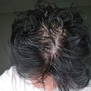 (주)골든에이바이오 | MTS앰플 탈모앰플 홈케어 : 30대 남성 두피 고민 해결해 줄 자란다(Jaranda) 사용 후기