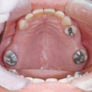 내포아산의원 | 아말감 교체 고민 끝! 수은 걱정보다 중요한 '이것' (2차 충치와 파절 위험)