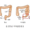 선천성 거대결장증[Hirschsprung disease]소아청소년질환, 소화기질환 이미지