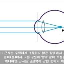 봄의약속안과] 우리 아이 근시 떄문에 걱정이라면...? 드림렌즈로 라식 효과를!!!????(강동구 드림렌즈,드림렌즈 효과) 이미지