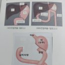 성모식품 | 서울성모병원 입원후기(6) - 위암절제수술 D+4