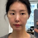 땅콩형 얼굴 해결방법.. 미디쎄놀 세럼 한달 후기2