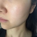 트리플 | 압구정피부과 기미잡티 레이저 피코트리플관리 후기