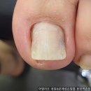 아델리오 네일&문제성손발톱 응암역촌점 네이버블로그