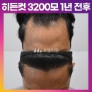 [얇은 모발 40대 남자 M자 비절개 모발이식 수술] 무삭발 히든컷 3200모 1년 후기 (모엠의원/M자탈모/전지훈원장) 이미지