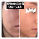 라포약국 | 신사역성형외과 오래가는 라포엘 실 투명브이리프팅 2주차 후기
