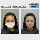 영헤어라인 이미지