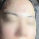 여드름 유목민 정착한 압출 맛집, 신정 영에스테틱 내돈내산 솔직후기
