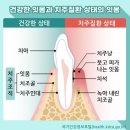 당뇨병과 밀접한 &#39;치주질환&#39; 원인과 예방·치료법은? 이미지